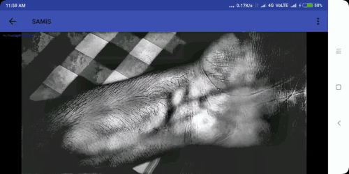Real-time vein visualization output from SAMIS